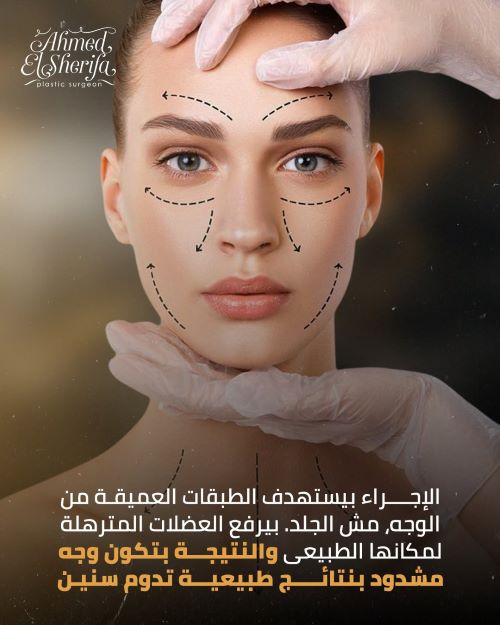 نتيجة تدوم لسنين بعد شد الوجه